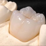 Dental Crowns Costa Rica