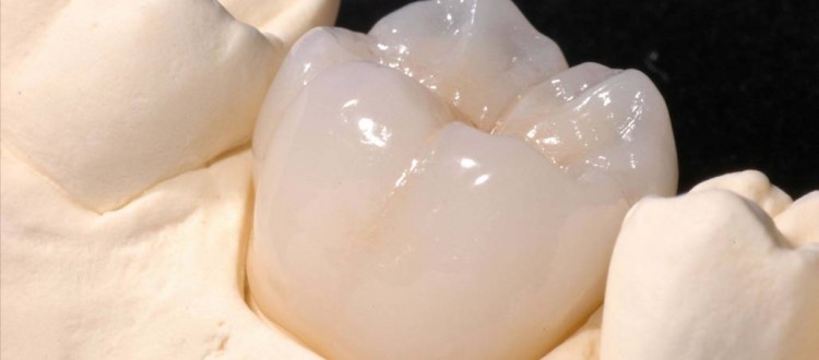 Dental Crowns Costa Rica
