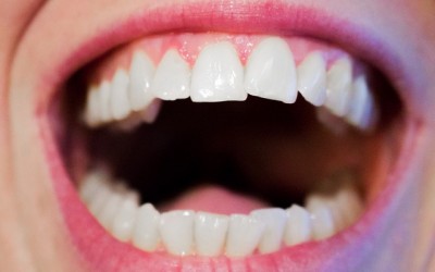 All on 8 dental Costa Rica