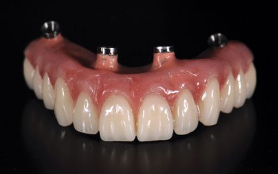 Best dentists for all-on-4 treatment Costa Rica