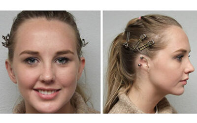 Silicone Prosthetic Ear: Restoring Confidence and Natural Appearance